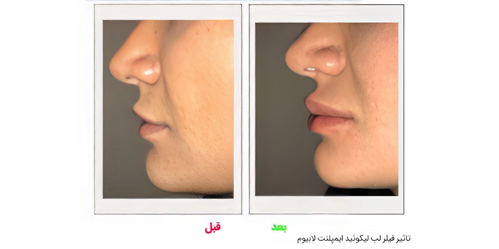 فیلر لیکویید ایمپلنت