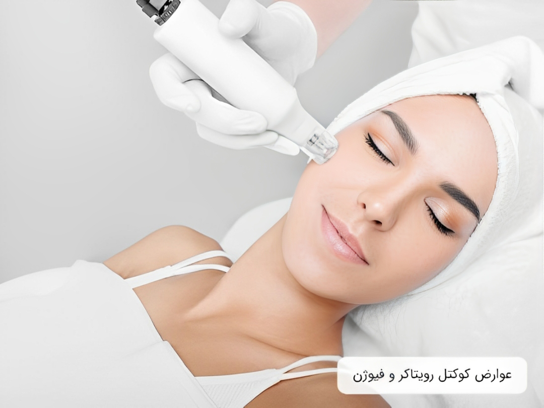 رویتاکر یا فیوژن