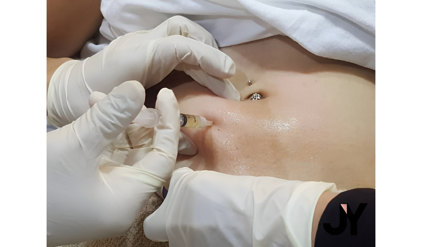 نحوه تزریق کوکتل لاغری فیوژن