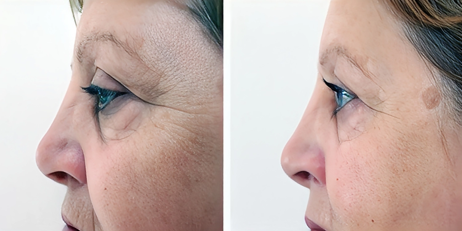 نتایج درمان پیری پوست با فیوژن